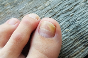 Causes and Risk Factors for Toenail Fungus