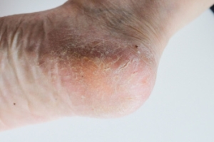 Mobility Threats and Risk Factors of Cracked Heels