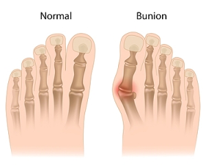 Understanding Bunions