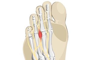 Causes and Prevention of Morton’s Neuroma