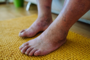 Diabetic Limb Salvage and Podiatrists