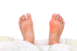 Do I Need Bunion Surgery?