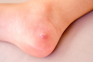 Causes of Friction Blisters on the Feet