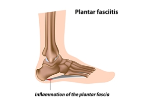 Causes and Symptoms of Plantar Fasciitis