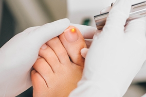 Facts About Laser Treatment for Toenail Fungus