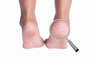 How Cracked Heels Form