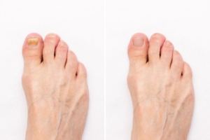 Types of Toenail Infections