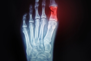 Causes and Treatment of a Broken Toe