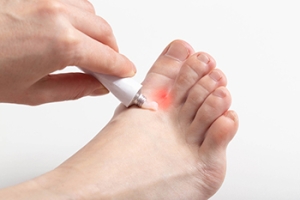 Symptoms and Prevention of Athlete’s Foot