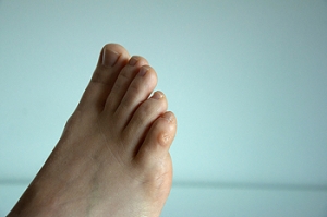 Are Corns Painful?