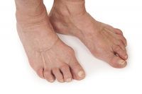 The Feet and Rheumatoid Arthritis