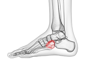 Cuboid Syndrome in Active Individuals