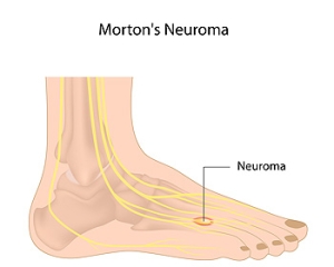 What Is This Pain in the Ball of My Foot?