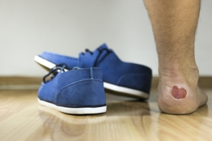 Dealing With Blisters on the Feet