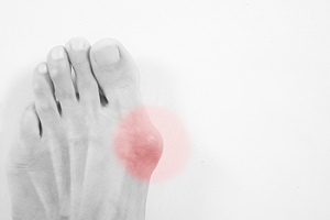 Types of Bunions