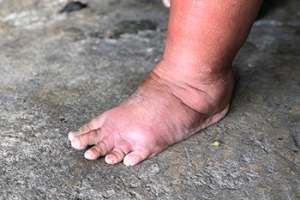 Swollen Feet From Tight Shoes