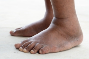 Causes of Foot Swelling