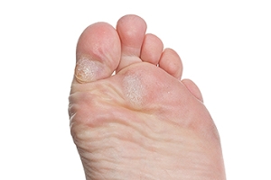 Managing Pain From Pachyonychia Congenita